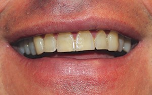 facetas-antes